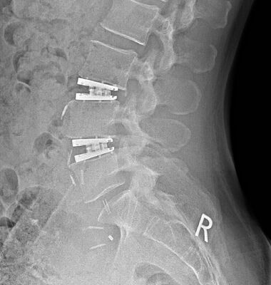 Via4Spine - LP-ESP LUMBALE BANDSCHEIBENPROTHESE - Bild 5 Via4Spine - LP-ESP LUMBALE BANDSCHEIBENPROTHESE - Bild 5