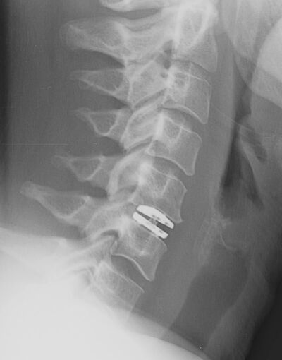 Via4SPINE - CP-ESP ZERVIKALE BANDSCHEIBENPROTHESE - BILD 4 Via4SPINE - CP-ESP ZERVIKALE BANDSCHEIBENPROTHESE - BILD 14
